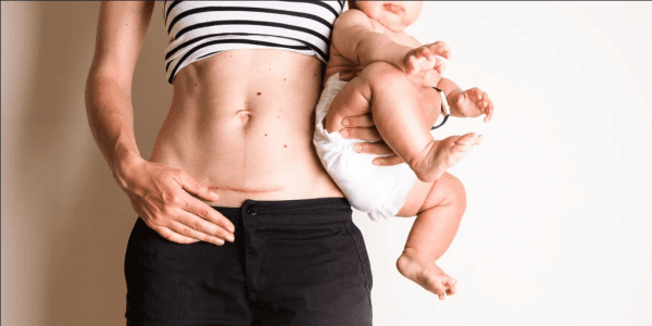 ربط البطن بعد الولادة القيصرية
