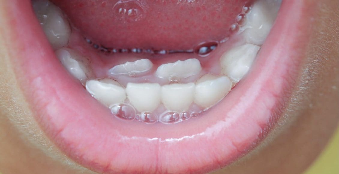 ظهور الأسنان الدائمة خلف اللبنية