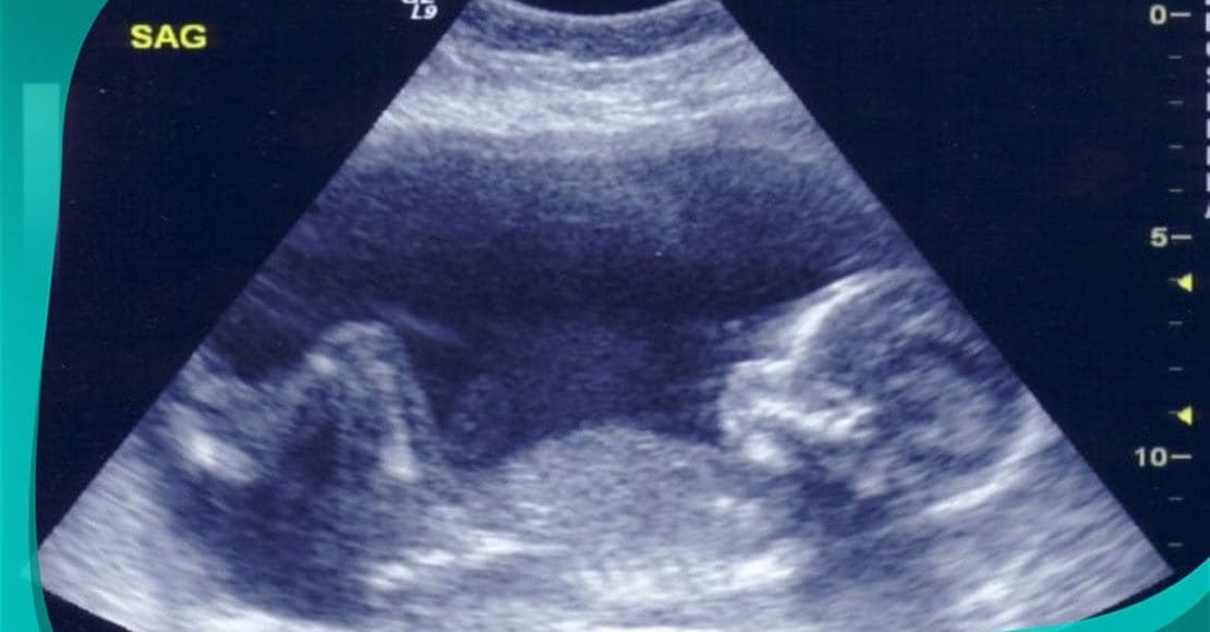 هل يخطئ السونار في تحديد نوع الجنين الشهر التاسع