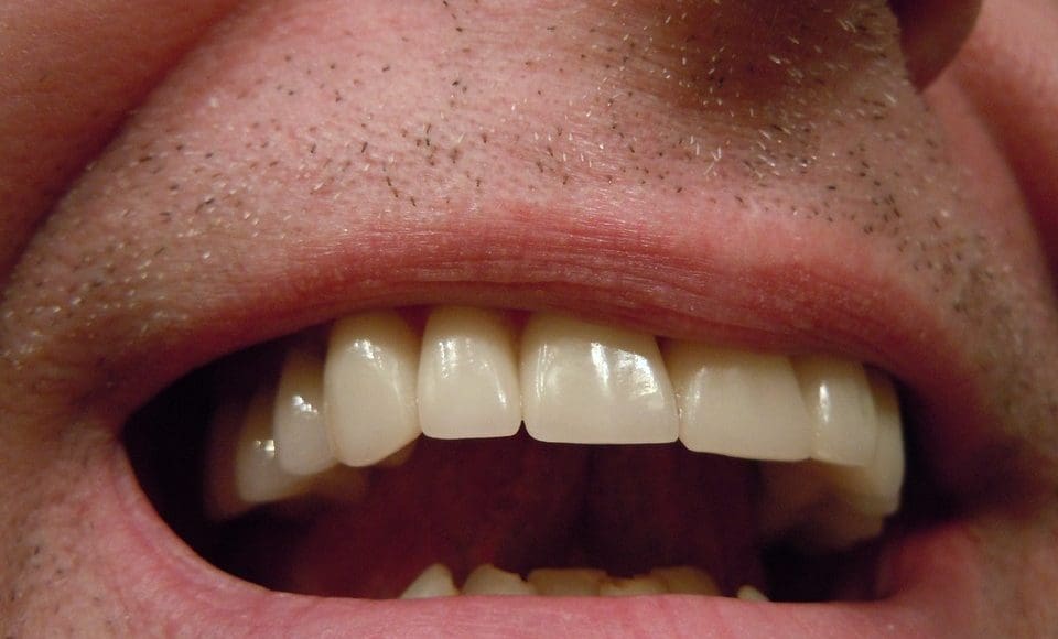 هل يوجد علاج لتثبيت الأسنان المخلخلة