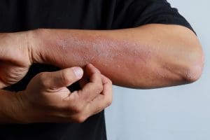 علاج حساسية الجلد والهرش