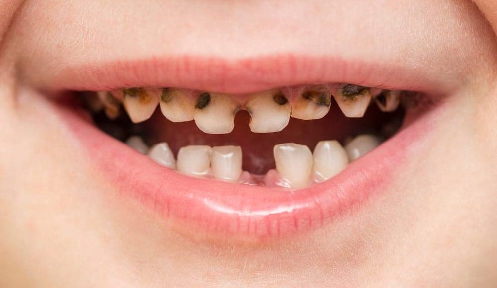 تفسير حلم الأسنان السوداء