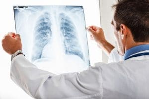 كيف يموت مريض سرطان الرئة
