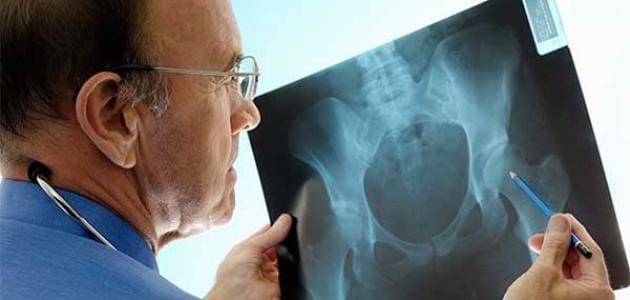 كم من العمر يعيش مريض سرطان العظام