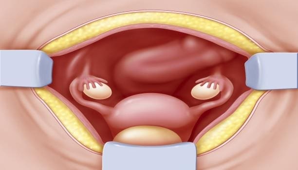 كيف أعرف أن الرحم رجع مكانه بعد الولادة القيصرية