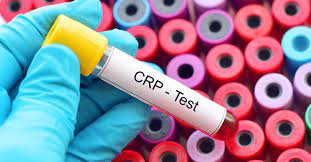 هل تحليل CRP يكشف السرطان