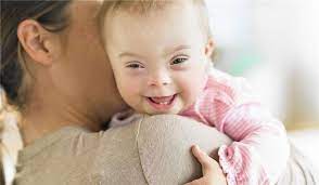 أطفال متلازمة داون حديثي الولادة