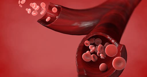 هل نقل الدم يرفع الهيموجلوبين