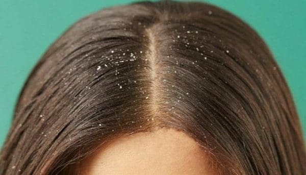 أسباب قشرة الشعر عند النساء