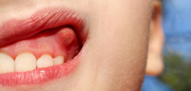 أسباب الخراج في الأسنان