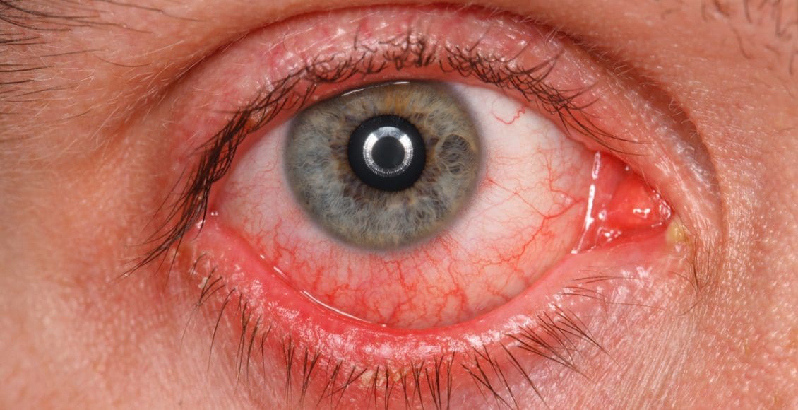 علاج الشعيرات الدموية في العين