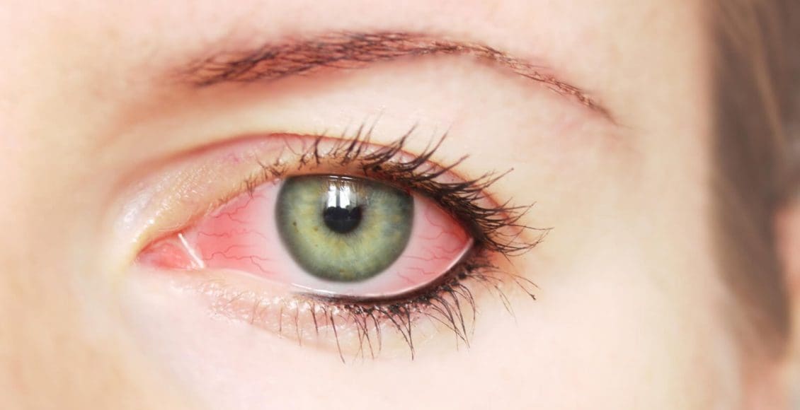 علاج ارتفاع ضغط العين في المنزل