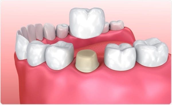 أسباب ألم الأسنان الملبسة