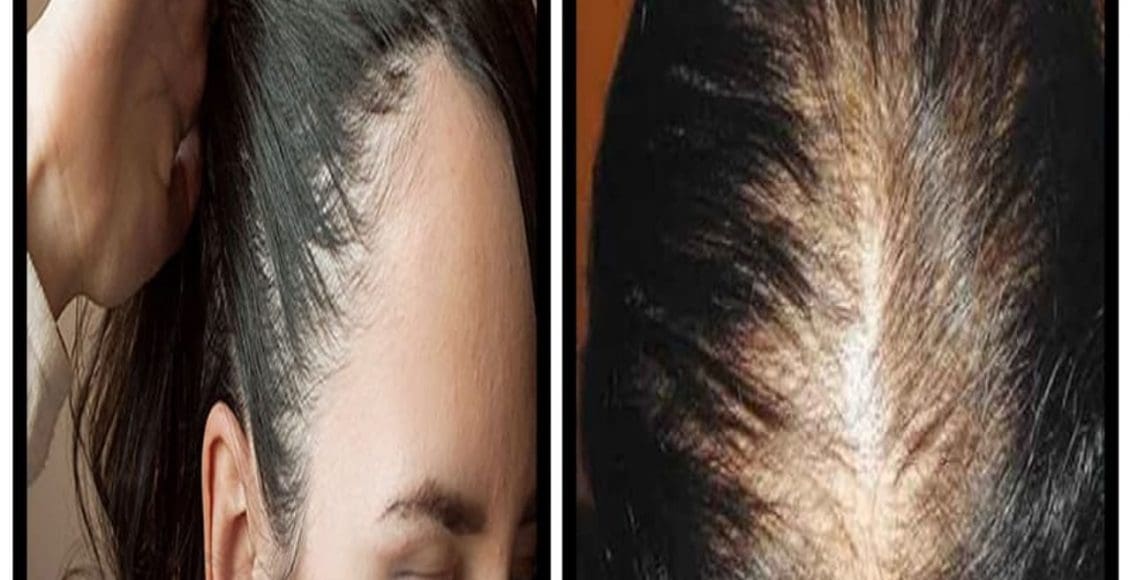 علاج فراغات الشعر والصلع