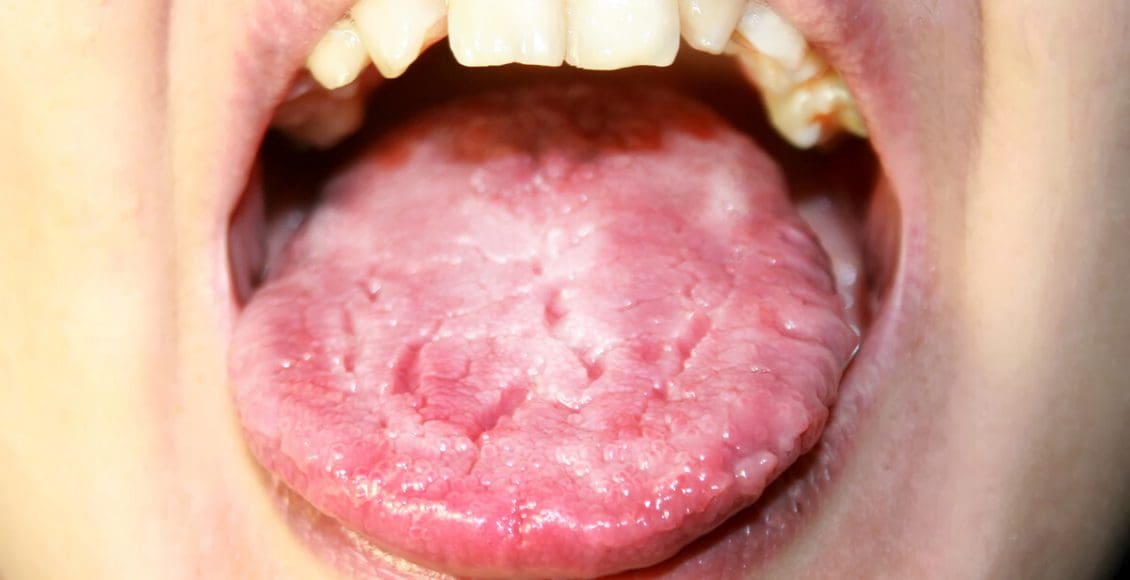 أدوية علاج فطريات الفم واللسان