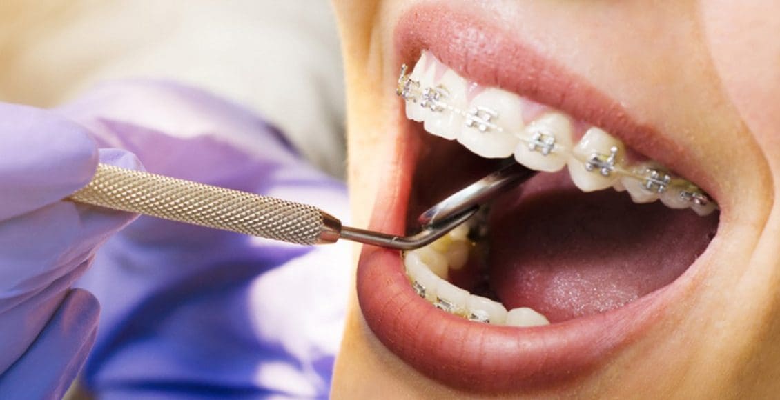 هل تقويم الأسنان مؤلم