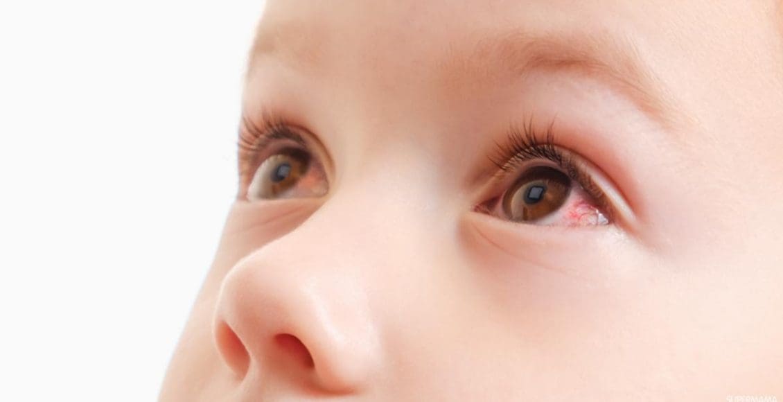 أسباب احمرار العين عند الأطفال