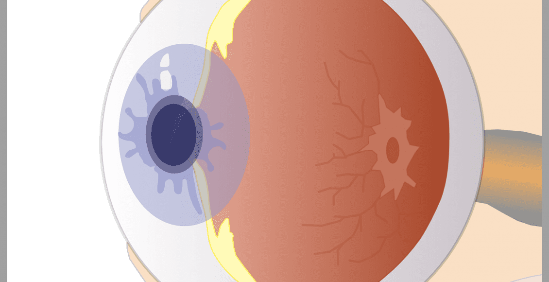 أعراض التهاب شبكية العين