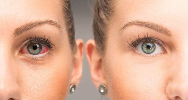الفرق بين التهاب العين الفيروسي والبكتيري