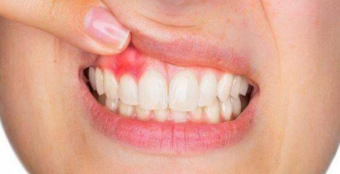 هل التهاب اللثة يسبب ألم الأسنان