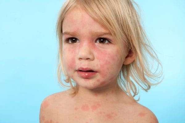 10 أمراض جلدية تصيب الأطفال بالصور