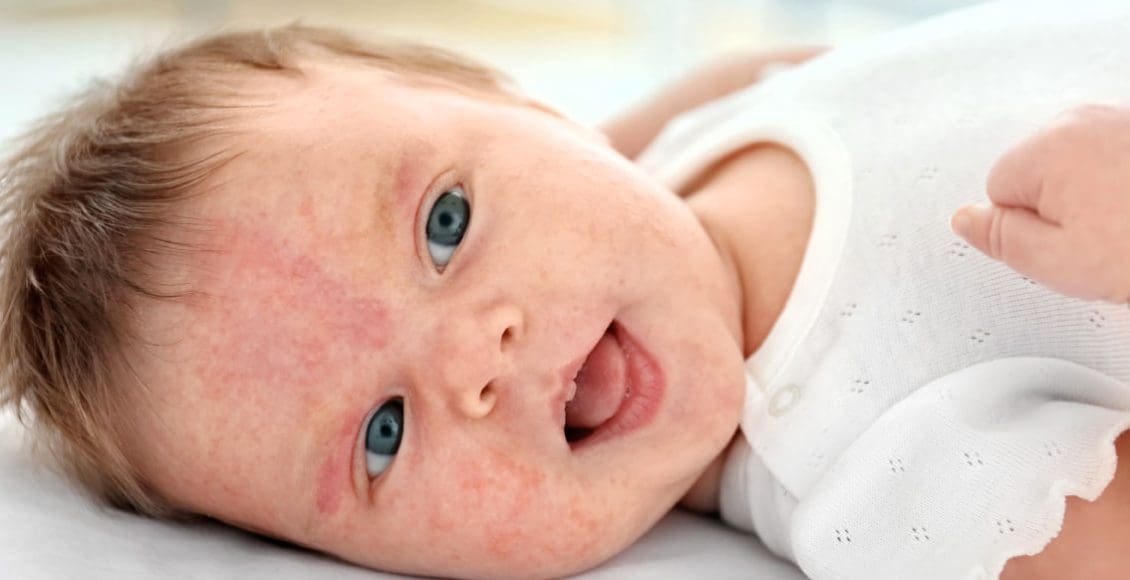 أعراض حساسية اللبن عند الرضع