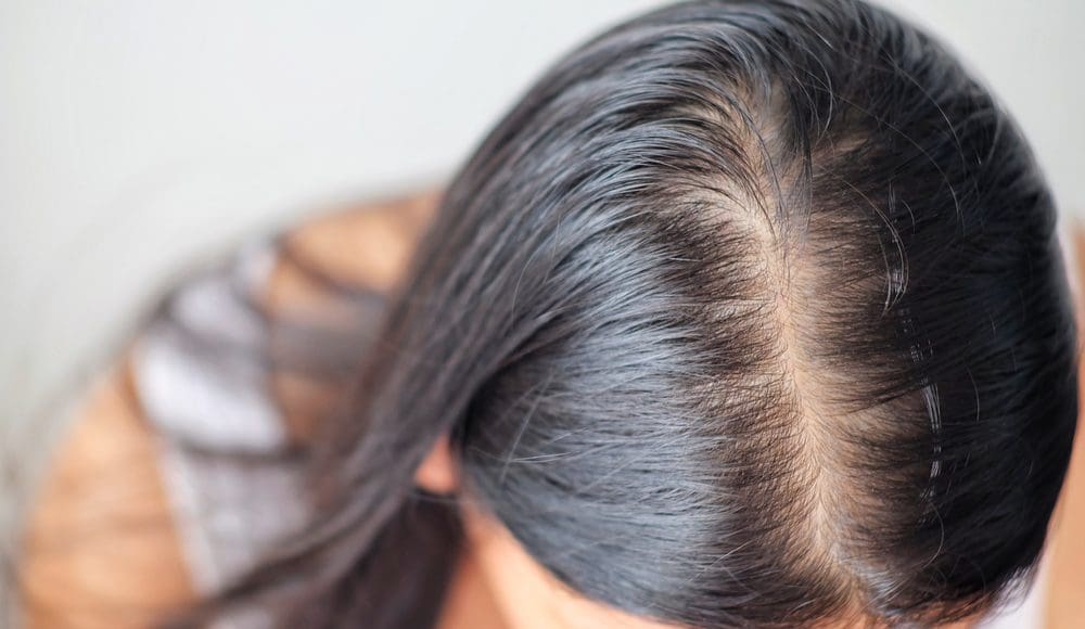 علاج فراغات الشعر الأمامية للنساء