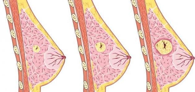 ما هو الورم الليفي في الثدي
