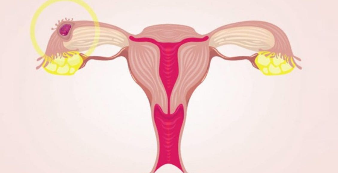 أسباب الحمل خارج الرحم وعلاجه