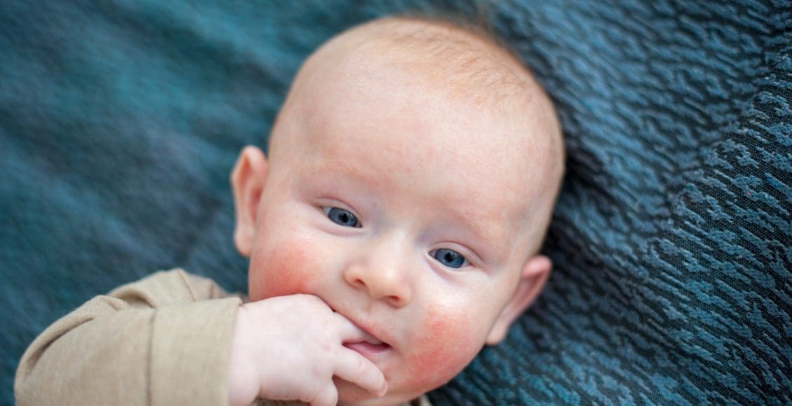 أعراض حساسية اللاكتوز عند الرضع