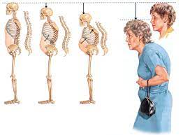 أعراض هشاشة العظام عند النساء