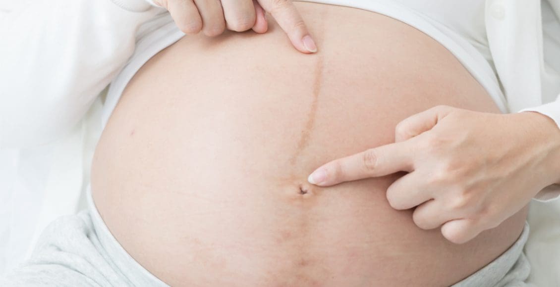 شكل خط البطن أثناء الحمل بولد
