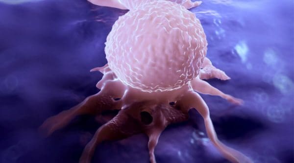 سرطان الثدي المرحلة الثانية وعلاجها