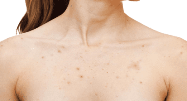 ظهور حبة تحت الجلد في الثدي الأيمن – زيادة