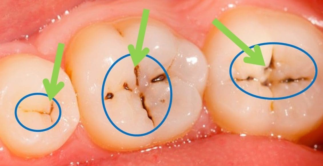كيفية إزالة التسوس من الأسنان عند الطبيب
