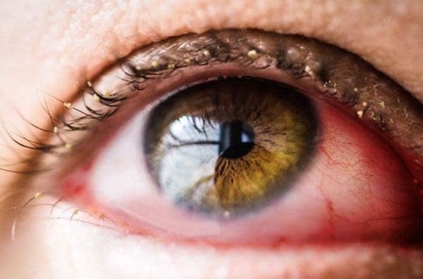 علاج التهاب ملتحمة العين البكتيري