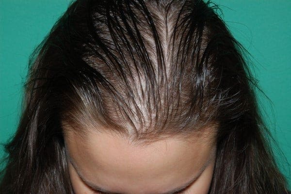 عند علاج الشديد تساقط النساء الشعر ما هي