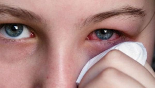علاج جفاف العين الشديد