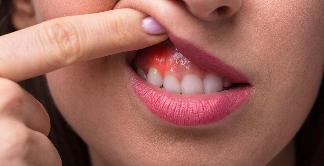 علاج خراج الأسنان بالمضاد الحيوي