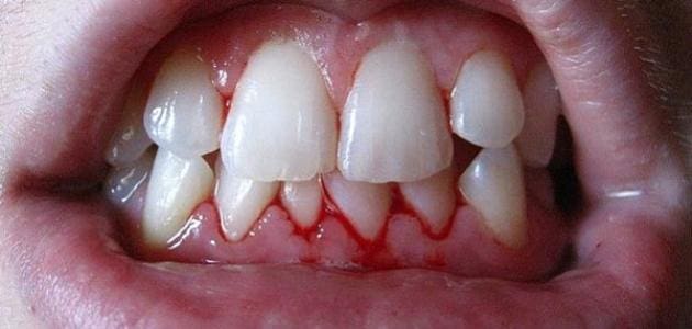 تفسير حلم خروج الدم من الأسنان