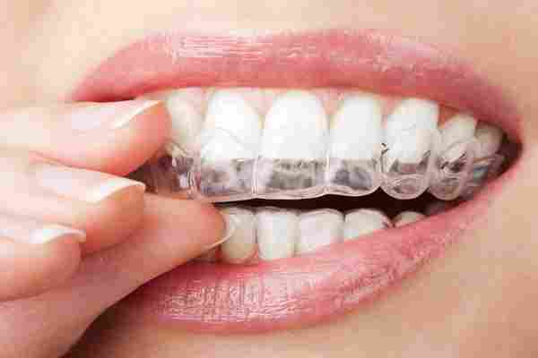 أنواع تقويم الأسنان بالصور واسعارها