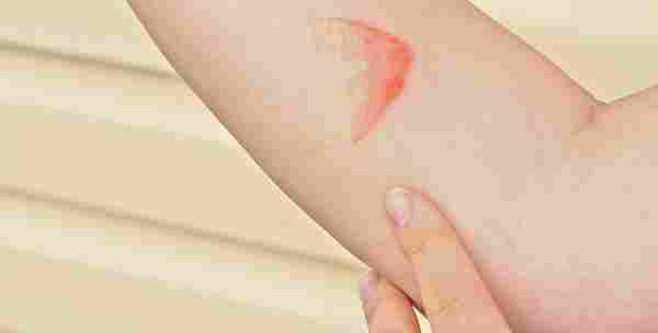 علاج حروق المكواة على الجلد