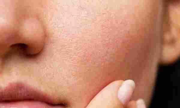 علاج مسامات الوجه بالاعشاب