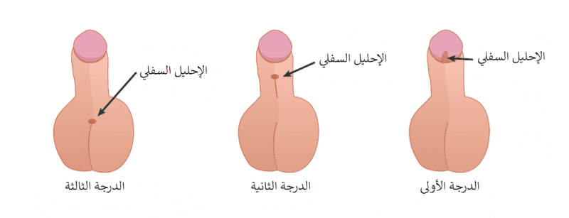 الشكل الطبيعي للعضو الذكري للطفل